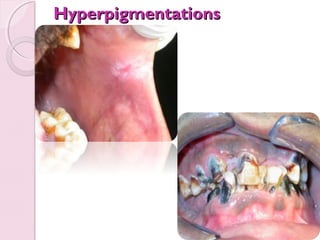 Hyperpigmentations

 