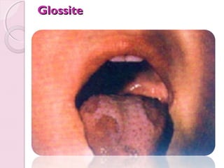 Glossite

 