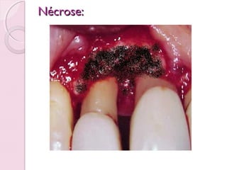 Nécrose:

 
