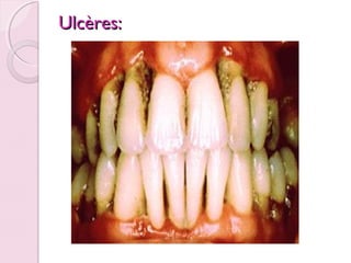Ulcères:

 