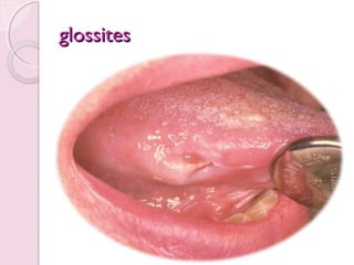 glossites

 