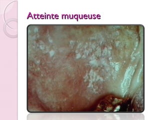 Atteinte muqueuse

 