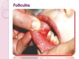 Folliculite

 