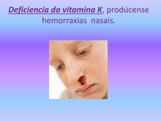 Deficiencia da vitamina K, prodúcense
hemorraxias nasais.
 