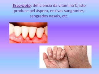 Escorbuto: deficiencia da vitamina C, isto
produce pel áspera, enxivas sangrantes,
sangrados nasais, etc.
 