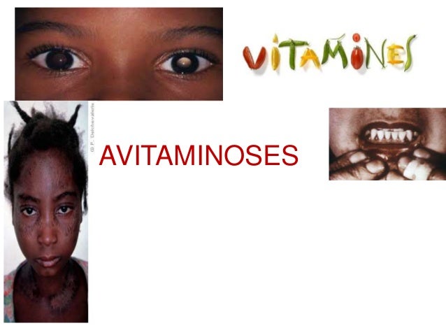 Avitaminose C’Est Quoi – Avitaminose: Symptômes et Traitement – MKXXKX