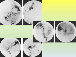 Arteriovenous Malformation (AVM) of Brain | PPTX