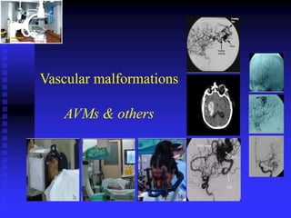 AVM, Vascular Malformation