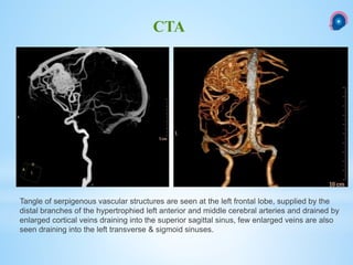 CTA
Tangle of serpigenous vascular structures are seen at the left frontal lobe, supplied by the
distal branches of the hypertrophied left anterior and middle cerebral arteries and drained by
enlarged cortical veins draining into the superior sagittal sinus, few enlarged veins are also
seen draining into the left transverse & sigmoid sinuses.
 
