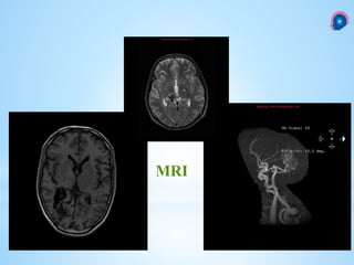 MRI
 