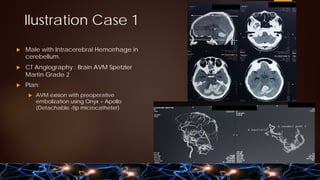 Brain AVM by Neurosurgery - Point of View.pdf