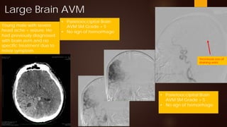Brain AVM by Neurosurgery - Point of View.pdf