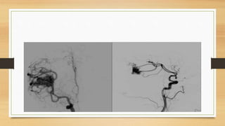 AVM Brain.pptx