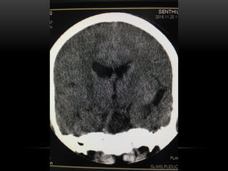 AVM Brain-Dr Sumit Sharma MD(RD), PDF (IO).pptx