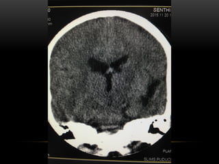 AVM Brain-Dr Sumit Sharma MD(RD), PDF (IO).pptx