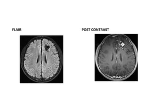 FLAIR POST CONTRAST
 