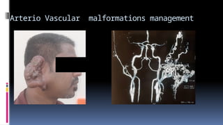 Vascular malformations of the head and neck surgical perspective Prof ...