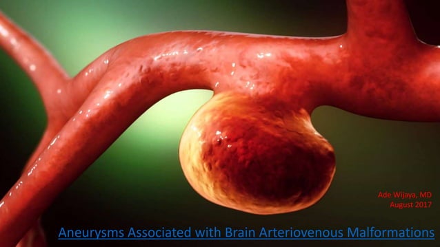 Brain AVM related aneurysms | PPT