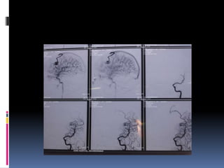 brain AVMs | PPTX