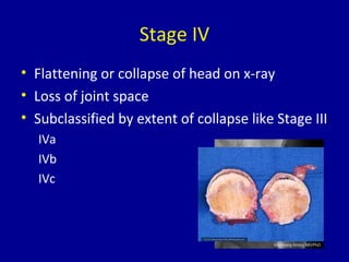 Stage IV
• Flattening or collapse of head on x-ray
• Loss of joint space
• Subclassified by extent of collapse like Stage III
IVa
IVb
IVc
 