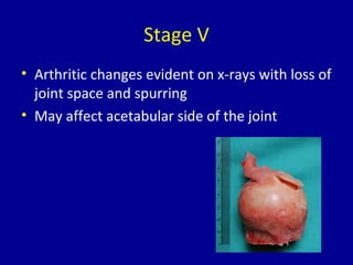 Stage V
• Arthritic changes evident on x-rays with loss of
joint space and spurring
• May affect acetabular side of the joint
 