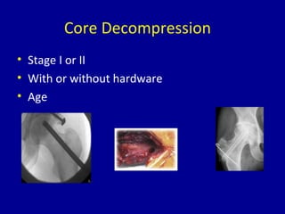 Core Decompression
• Stage I or II
• With or without hardware
• Age
 