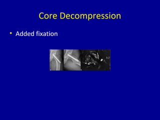 Core Decompression
• Added fixation
 