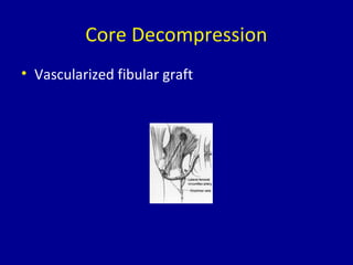 Core Decompression
• Vascularized fibular graft
 
