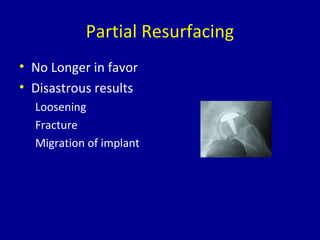Partial Resurfacing
• No Longer in favor
• Disastrous results
Loosening
Fracture
Migration of implant
 