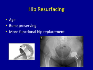 Hip Resurfacing
• Age
• Bone preserving
• More functional hip replacement
 