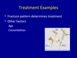 Treatment Examples
• Fracture pattern determines treatment
• Other factors
Age
Comorbidities
 