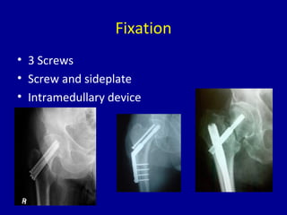 Fixation
• 3 Screws
• Screw and sideplate
• Intramedullary device
 