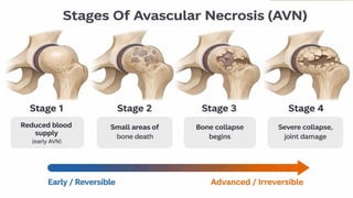 Comprehensive Overview of Avascular Necrosis (AVN): Causes, Diagnosis ...