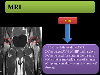 MRI 
MRI 
1. If X ray fails to show AVN. 
2.Can detect AVN of HIP within days 
3.Can be used for staging the disease 
4.MR...