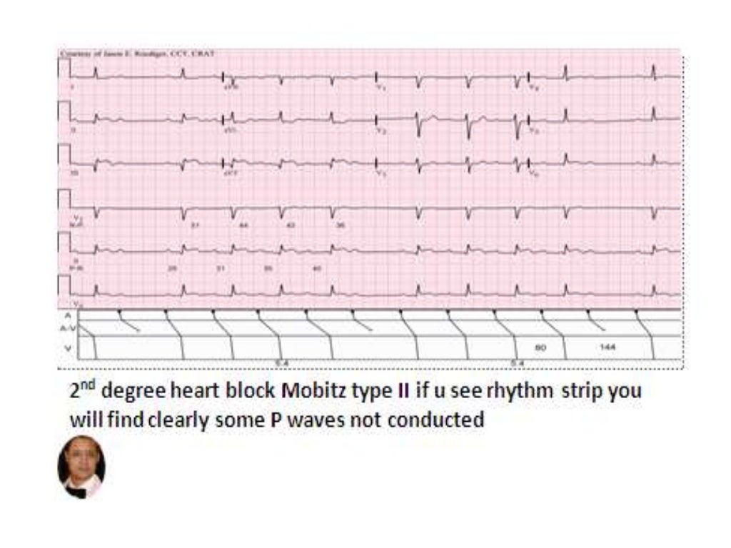 Av nodal heart blocks by dr bashir ahmed dar associate professor medi…