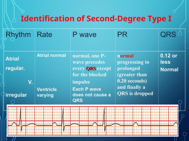 lecture on AV conduction defect of heart | PPT