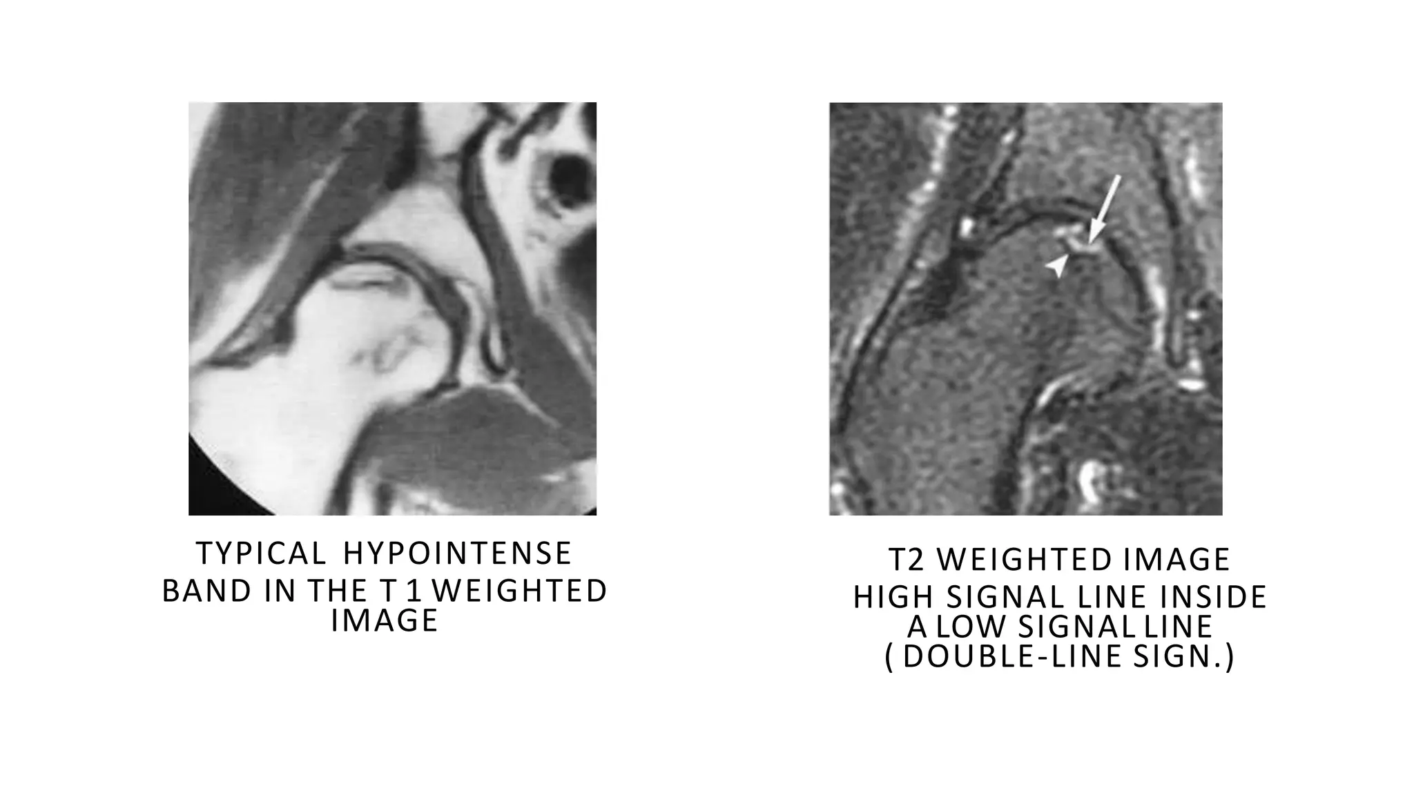 Avn of femoral head | PPTX