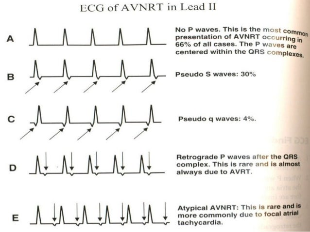 AVNRT AVNRT