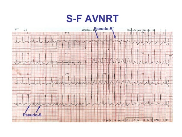 avnrt