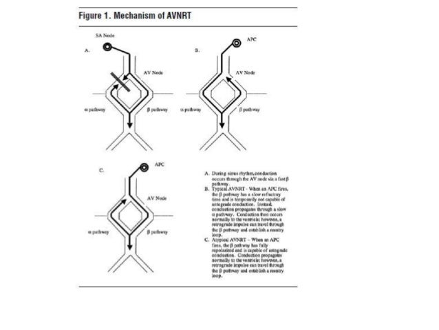 avnrt