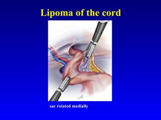 Lipoma of the cord sac rotated medially 