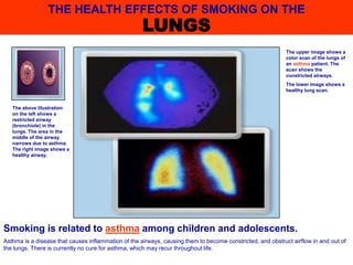 Smoking is related to asthma among children and adolescents.
Asthma is a disease that causes inflammation of the airways, causing them to become constricted, and obstruct airflow in and out of
the lungs. There is currently no cure for asthma, which may recur throughout life.
The upper image shows a
color scan of the lungs of
an asthma patient. The
scan shows the
constricted airways.
The lower image shows a
healthy lung scan.
The above illustration
on the left shows a
restricted airway
(bronchiole) in the
lungs. The area in the
middle of the airway
narrows due to asthma.
The right image shows a
healthy airway.
THE HEALTH EFFECTS OF SMOKING ON THE
LUNGS
 