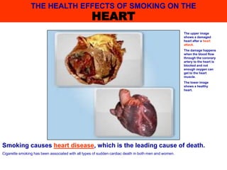 Smoking causes heart disease, which is the leading cause of death.
Cigarette smoking has been associated with all types of sudden cardiac death in both men and women.
The upper image
shows a damaged
heart after a heart
attack.
The damage happens
when the blood flow
through the coronary
artery to the heart is
blocked and not
enough oxygen can
get to the heart
muscle.
The lower image
shows a healthy
heart.
THE HEALTH EFFECTS OF SMOKING ON THE
HEART
 