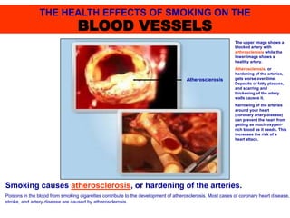 Smoking causes atherosclerosis, or hardening of the arteries.
Poisons in the blood from smoking cigarettes contribute to the development of atherosclerosis. Most cases of coronary heart disease,
stroke, and artery disease are caused by atherosclerosis.
The upper image shows a
blocked artery with
arthrosclerosis while the
lower image shows a
healthy artery.
Atherosclerosis, or
hardening of the arteries,
gets worse over time.
Deposits of fatty plaques,
and scarring and
thickening of the artery
walls causes it.
Narrowing of the arteries
around your heart
(coronary artery disease)
can prevent the heart from
getting as much oxygen-
rich blood as it needs. This
increases the risk of a
heart attack.
THE HEALTH EFFECTS OF SMOKING ON THE
BLOOD VESSELS
Atherosclerosis
 