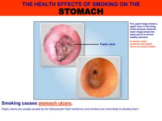 Smoking causes stomach ulcers.
Peptic ulcers are usually caused by the Helicobacter Pylori bacterium and smokers are more likely to develop them.
The upper image shows a
peptic ulcer in the lining
of the stomach while the
lower image shows the
lower part of a normal
healthy stomach.
In severe cases,
problems with peptic
ulcers can lead to death.
THE HEALTH EFFECTS OF SMOKING ON THE
STOMACH
Peptic ulcer
 