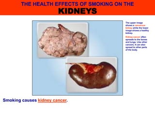 Smoking causes kidney cancer.
The upper image
shows a cancerous
kidney while the lower
image shows a healthy
kidney.
Kidney cancer often
spreads to the bones
and lungs. Like other
cancers, it can also
spread to other parts
of the body.
THE HEALTH EFFECTS OF SMOKING ON THE
KIDNEYS
 