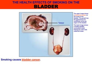Smoking causes bladder cancer.
The upper image shows
a cancerous tumour on
the inside of the
bladder. The growth has
the appearance of a
cauliflower at the top
region of the bladder.
The lower image shows
a healthy bladder
connected to both
kidneys by a thin tube
called the ureter.
Tumour
THE HEALTH EFFECTS OF SMOKING ON THE
BLADDER
 