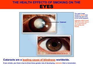 Cataracts are a leading cause of blindness worldwide.
If you smoke, you have a two to three times greater risk of developing cataracts than a nonsmoker.
THE HEALTH EFFECTS OF SMOKING ON THE
EYES
The upper image
shows a cataract that
causes the eye's lens
to turn white (opaque).
Cataracts make it more
difficult to read, drive a
car, or see faces of
your family and
friends.
Cataract
 