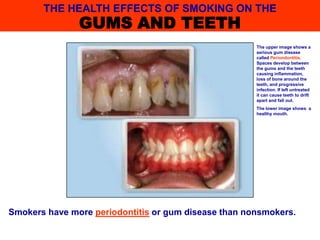 Smokers have more periodontitis or gum disease than nonsmokers.
The upper image shows a
serious gum disease
called Periondontitis.
Spaces develop between
the gums and the teeth
causing inflammation,
loss of bone around the
teeth, and progressive
infection. If left untreated
it can cause teeth to drift
apart and fall out.
The lower image shows a
healthy mouth.
THE HEALTH EFFECTS OF SMOKING ON THE
GUMS AND TEETH
 