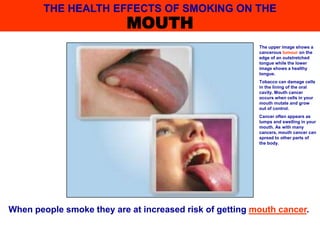 When people smoke they are at increased risk of getting mouth cancer.
The upper image shows a
cancerous tumour on the
edge of an outstretched
tongue while the lower
image shows a healthy
tongue.
Tobacco can damage cells
in the lining of the oral
cavity. Mouth cancer
occurs when cells in your
mouth mutate and grow
out of control.
Cancer often appears as
lumps and swelling in your
mouth. As with many
cancers, mouth cancer can
spread to other parts of
the body.
THE HEALTH EFFECTS OF SMOKING ON THE
MOUTH
 